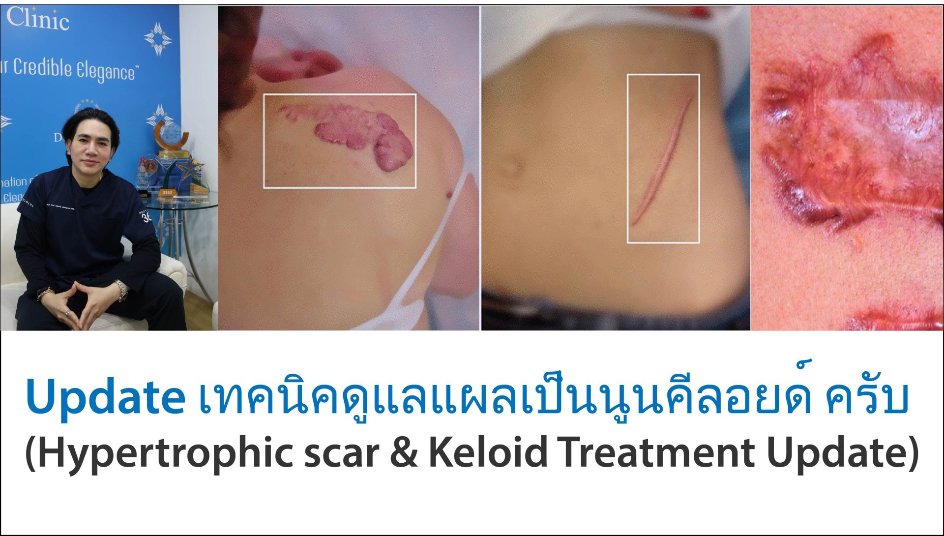 Update เทคนิคดูแลแผลเป็นนูนคีลอยด์ ครับ (Hypertrophic scar & Keloid Treatment Update)